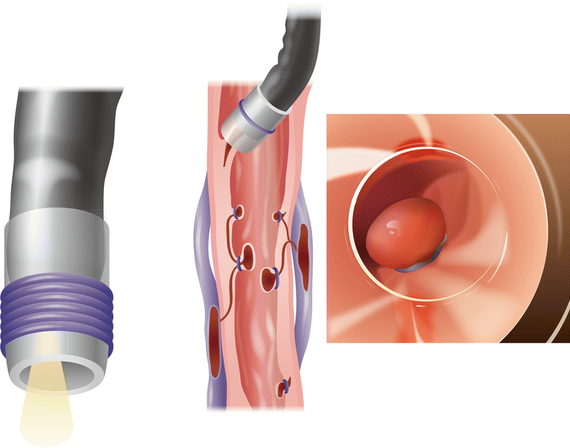 Esophageal Dilation
